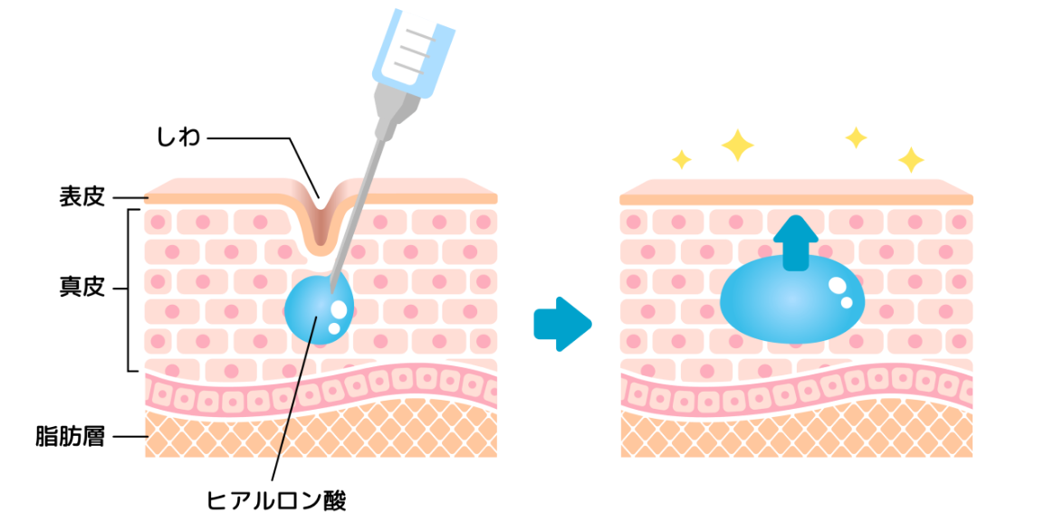 ヒアルロン酸注射の仕組みと効果